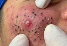 Acne Blackheads Extraction