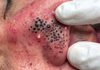 Cystic Blackheads Extraction