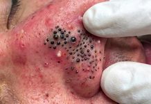 Cystic Blackheads Extraction