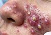 Big Cystic Acne Blackheads Extraction
