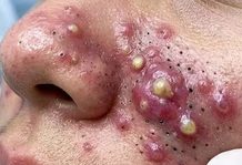 Big Cystic Acne Blackheads Extraction