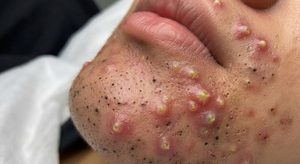 Blackheads Extraction Whiteheads