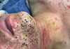 Blackheads Extraction Blackheads