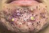 Big Cystic Blackheads Whiteheads