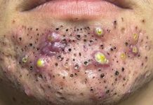 Big Cystic Blackheads Whiteheads