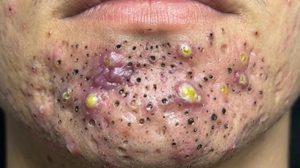 Big Cystic Blackheads Whiteheads