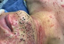 Blackheads Extraction Blackheads