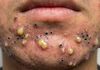 Big Blackheads Extraction Whiteheads