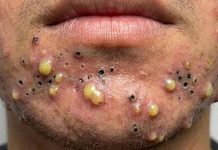 Big Blackheads Extraction Whiteheads