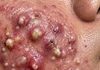 Blackheads Extraction Whiteheads