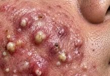 Blackheads Extraction Whiteheads