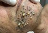 Blackheads Extraction Whiteheads
