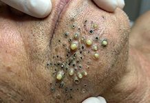 Blackheads Extraction Whiteheads