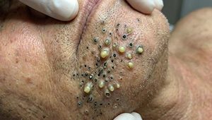 Blackheads Extraction Whiteheads