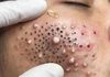 Acne Blackheads Extraction Whiteheads