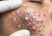 Acne Blackheads Extraction Whiteheads