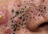 Blackheads Extraction