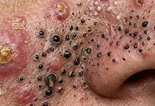 Blackheads Extraction