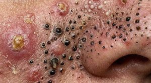 Blackheads Extraction