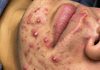 Acne Blackheads Extraction