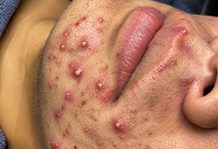 Acne Blackheads Extraction