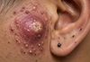Big Cystic Blackheads Extraction
