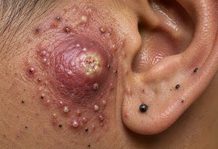 Big Cystic Blackheads Extraction