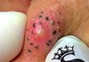 Big Cystic Blackheads Extraction