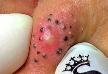 Big Cystic Blackheads Extraction