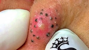 Big Cystic Blackheads Extraction