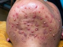 Blackheads Extraction Pimples