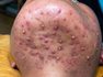 Blackheads Extraction Pimples