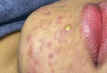 Extraction Whiteheads