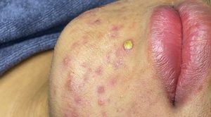 Extraction Whiteheads
