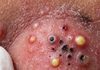 Blackheads Extraction Whiteheads