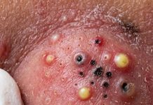 Blackheads Extraction Whiteheads