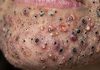 Blackheads Extraction