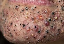 Blackheads Extraction