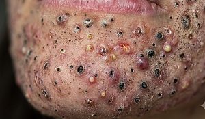 Blackheads Extraction