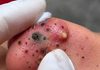 Cystic Blackheads Extraction