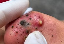 Cystic Blackheads Extraction