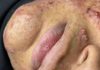 Acne Blackheads Extraction