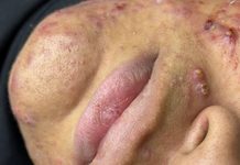 Acne Blackheads Extraction