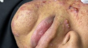 Acne Blackheads Extraction