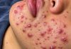 Acne Blackheads Extraction