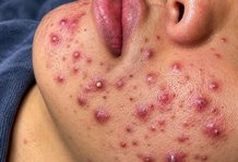 Acne Blackheads Extraction