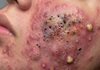 Blackheads Extraction