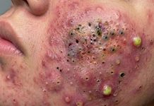 Blackheads Extraction