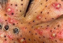 Blackheads Extraction