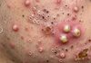 Cystic Acne Blackheads Extraction